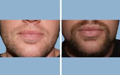 Before and After